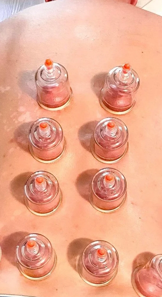 Overhead view of a person receiving cupping therapy with multiple suction cups placed across the back during treatment.