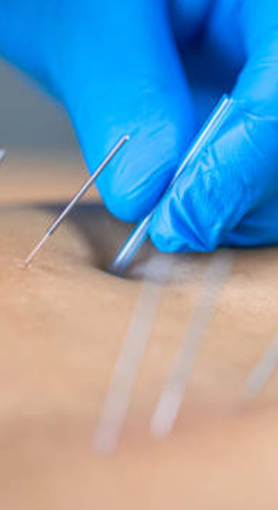 Close-up of a provider wearing blue gloves performing dry needling treatment with thin needles placed into soft tissue.